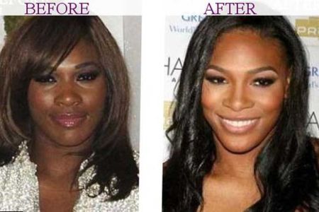 Serena Williams teeth before and after photos