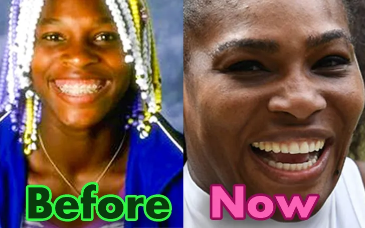 Serena Williams before and after photos