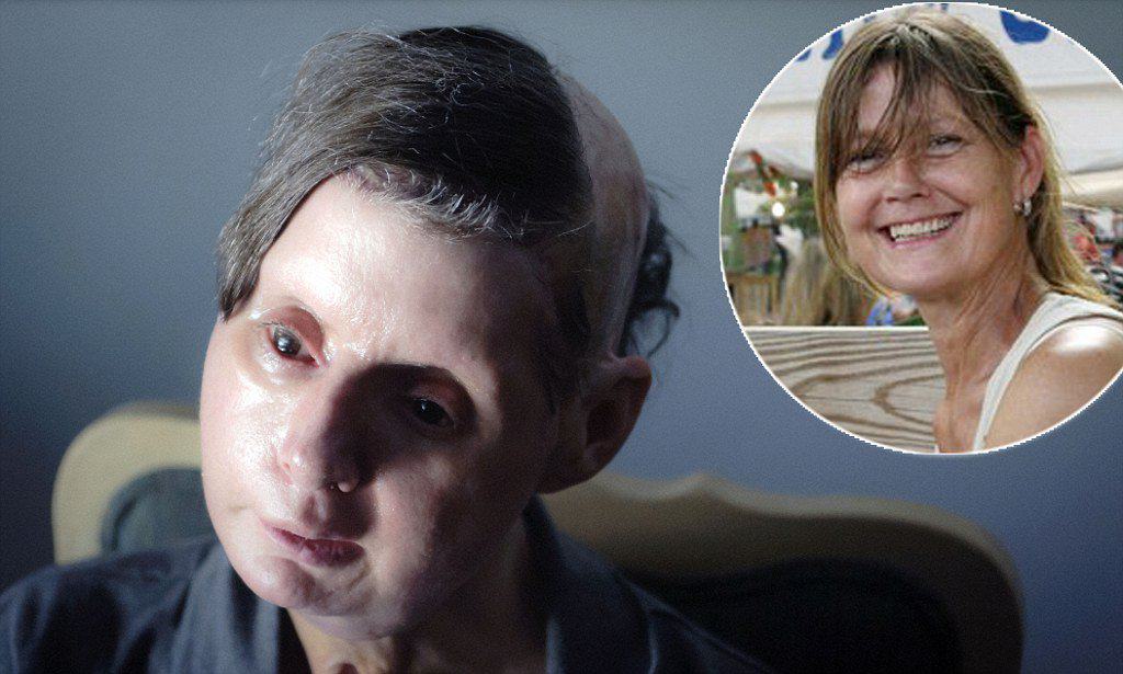 Astonishing progress of chimp attack victim Charla Nash, two years after receiving full-face transplant