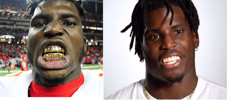 Tyreek Hill Teeth Before And After- Has Miami Dolphins WR Done A Surgery? 