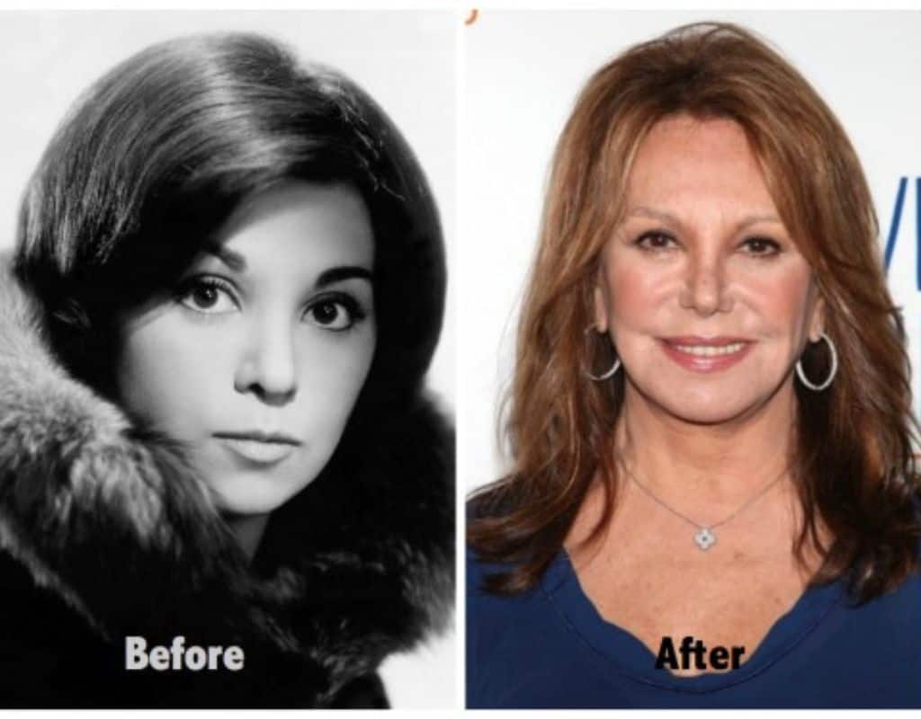 What Happened To Marlo Thomas Face