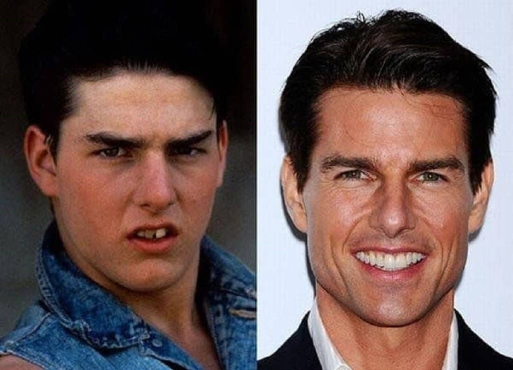 Tom Cruise teeth before and after. 