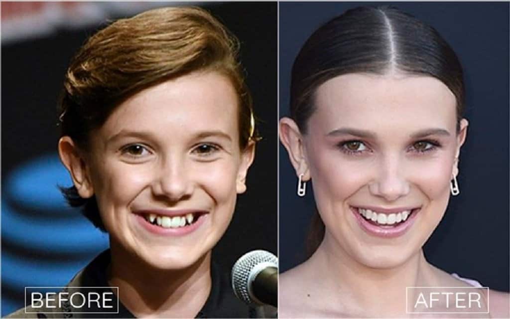 Millie Bobby Brown Teeth