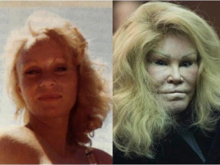 Cat Lady Plastic Surgery Before And After: What Happened To Her Face? 
